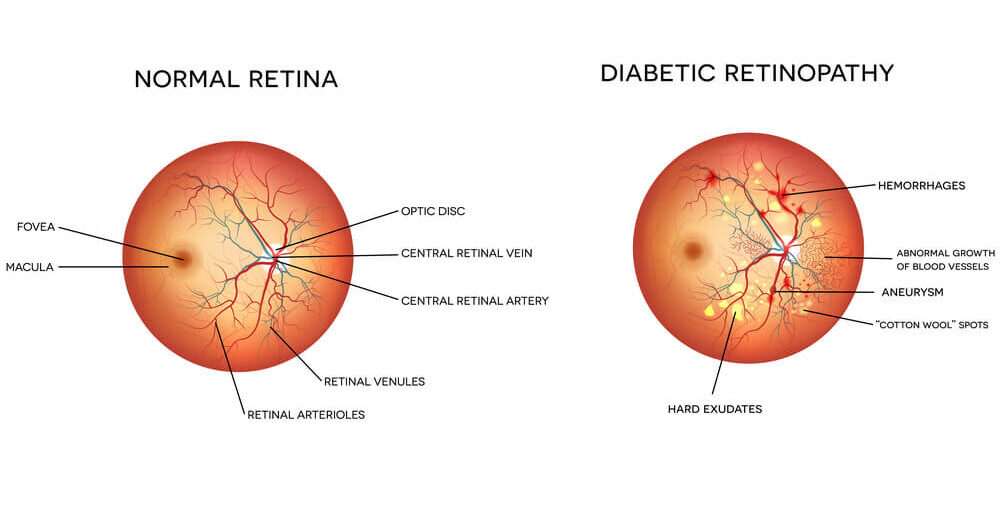 Graphic describing diabetic retinopathy